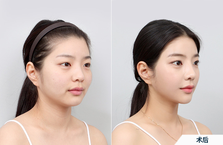before_after_45º