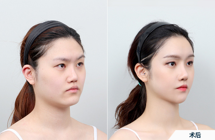 before_after_45º