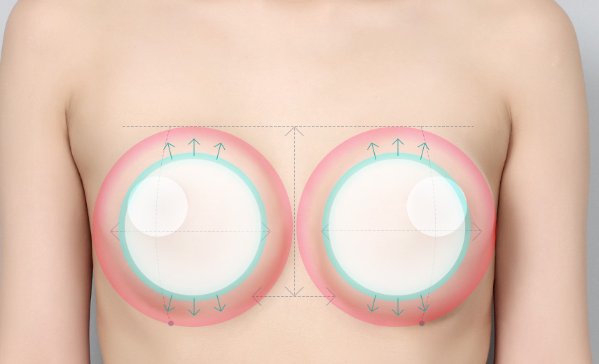 重新设定胸部空间大小，替换新的假体，改善形状和触触感。