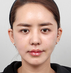 リフトアップBefore & AFTER