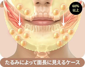 たるみによって面長に見えるケース