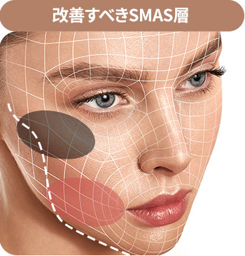 改善すべきSMAS層