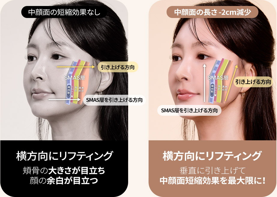 DA中顔面リフティング ディテール 이미지