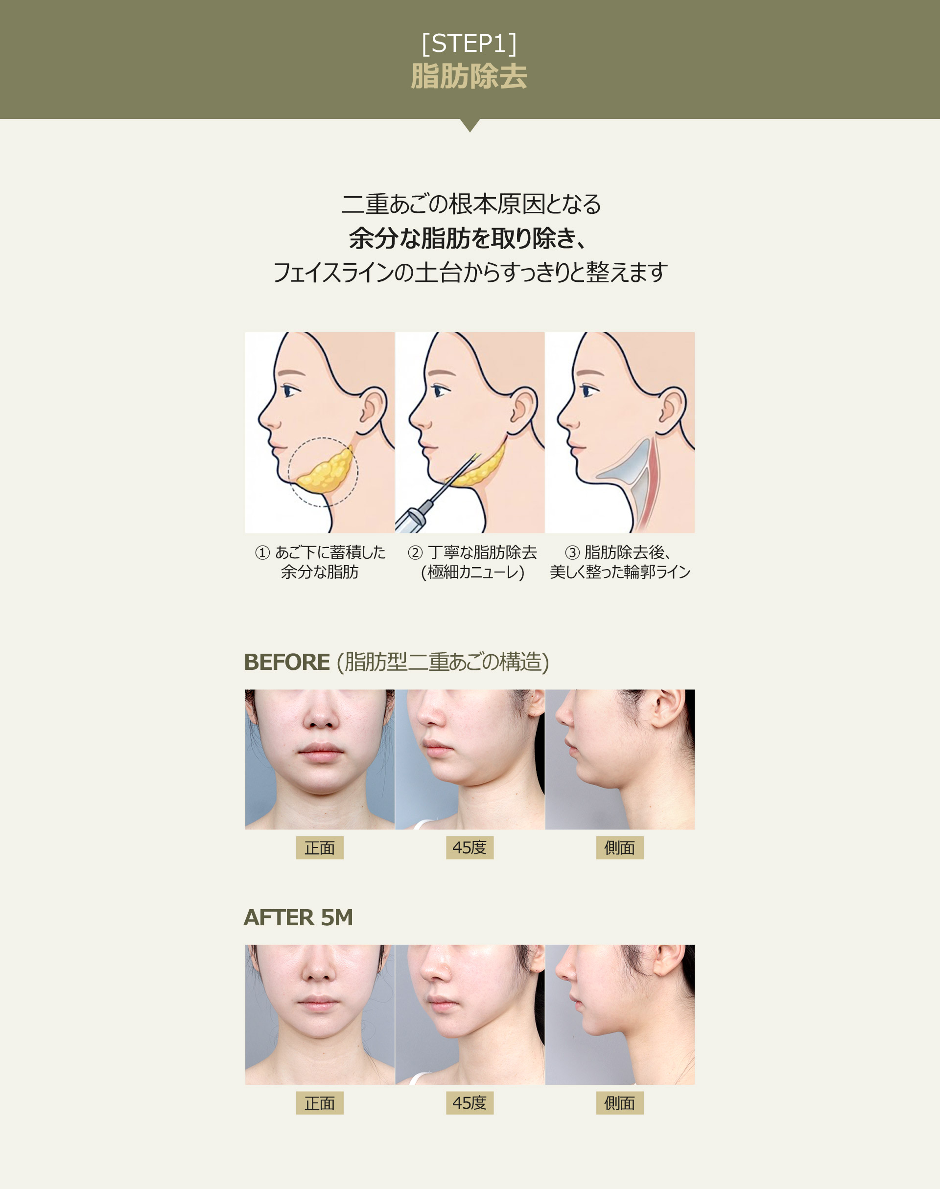 二重あごの根本原因となる余分な脂肪を取り除き、フェイスラインの土台からすっきりと整えます