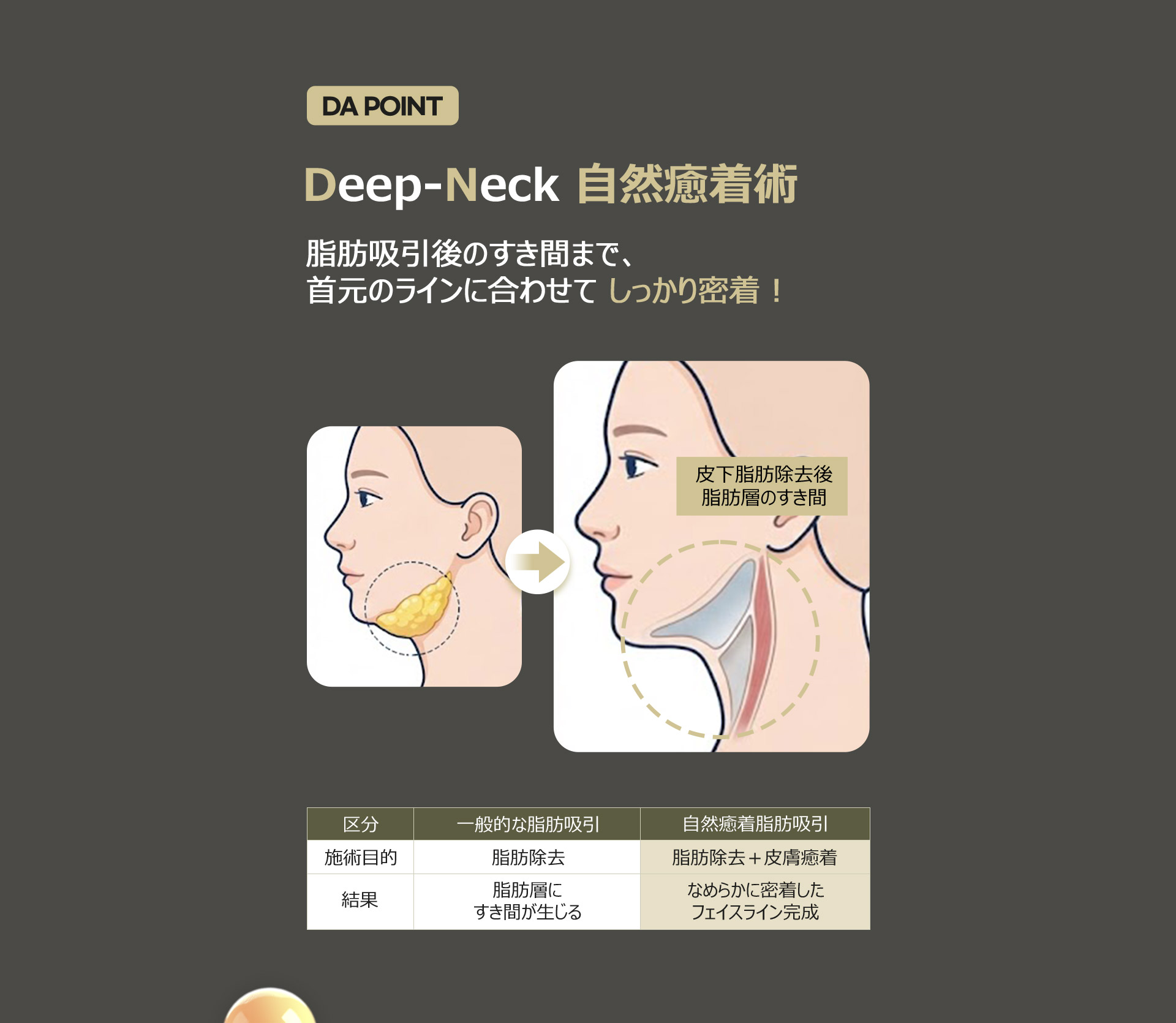 Deep-Neck 自然癒着術、 脂肪吸引後のすき間まで、首元のラインに合わせて しっかり密着！