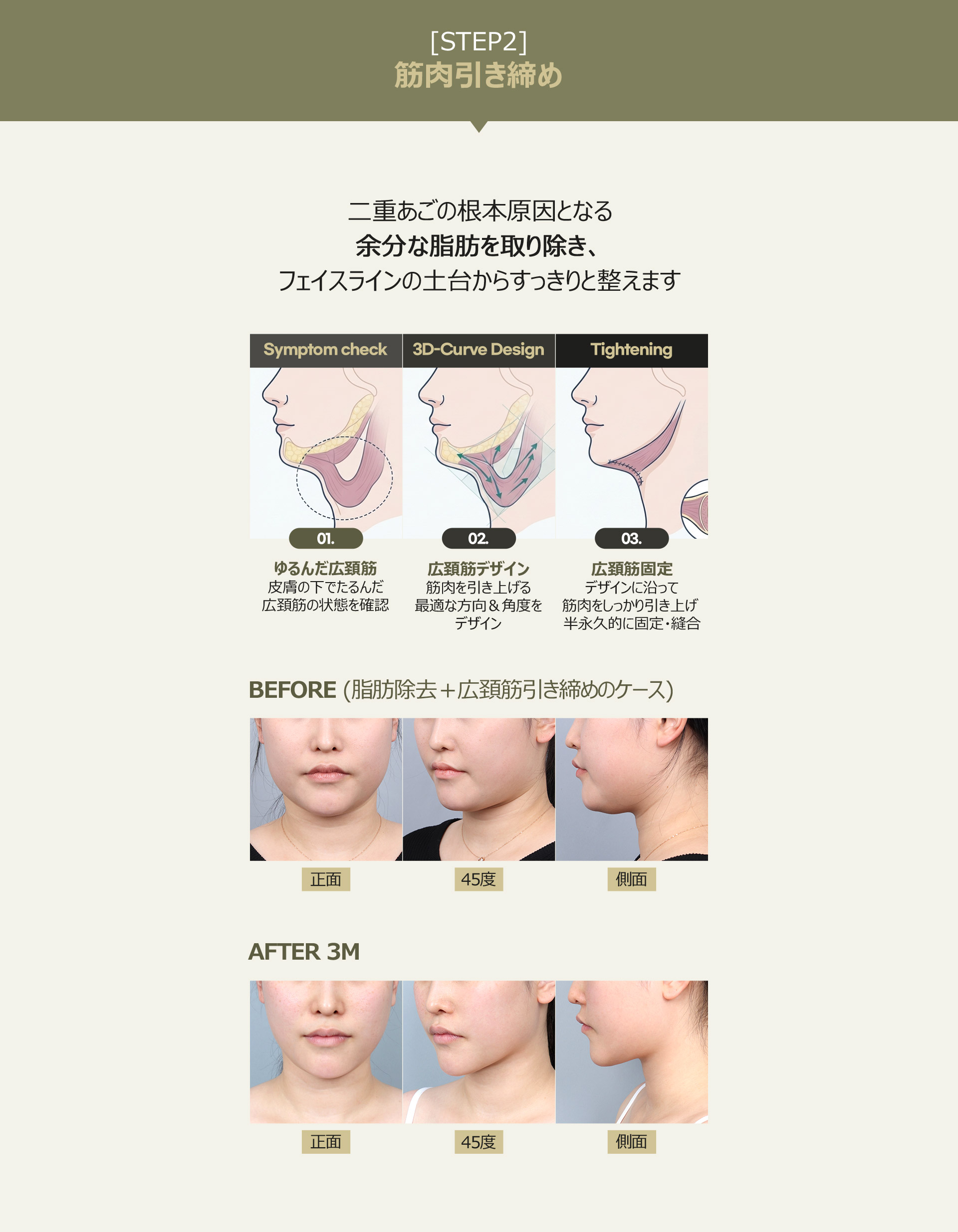 二重あごの根本原因となる余分な脂肪を取り除き、フェイスラインの土台からすっきりと整えます