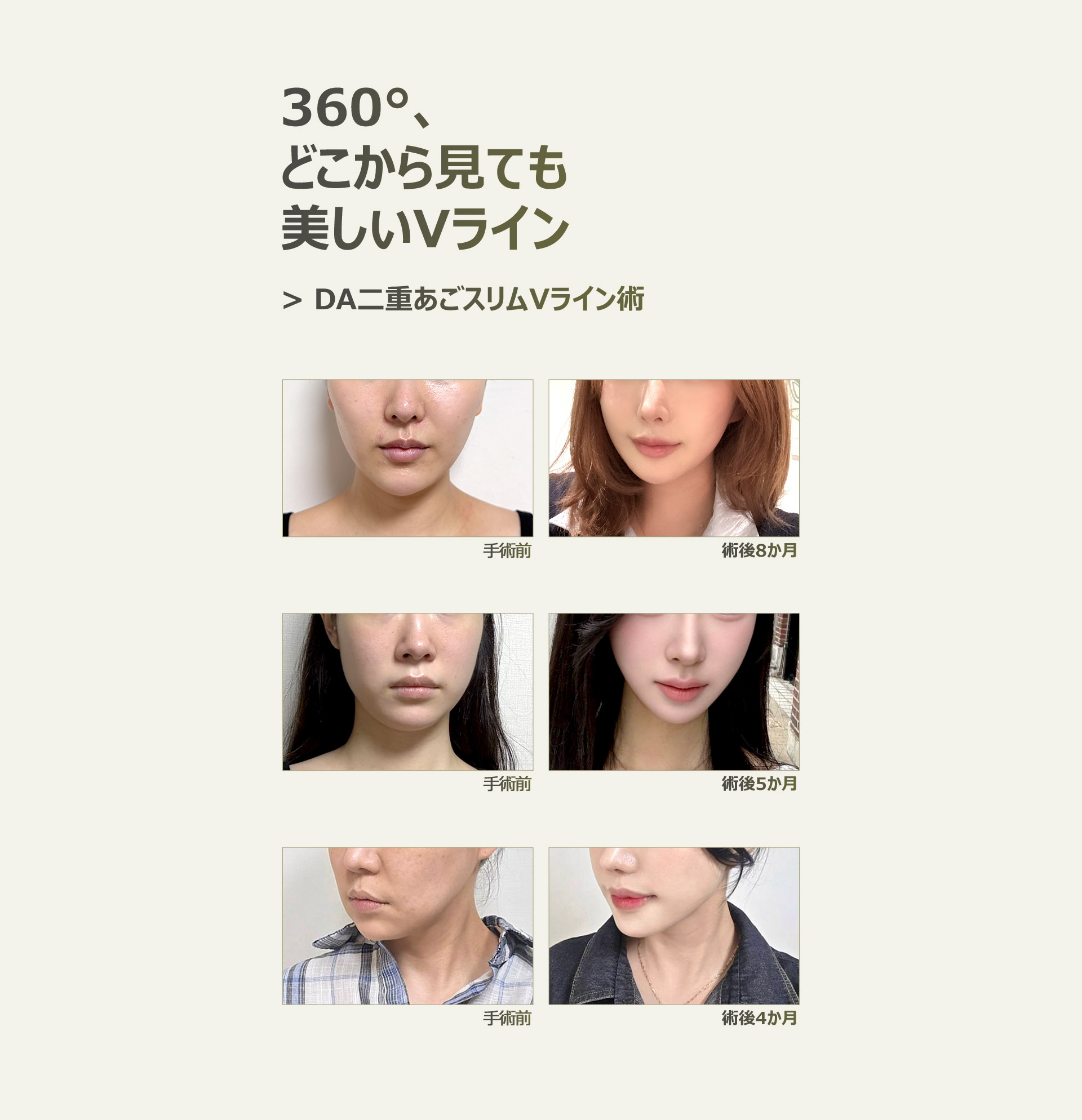 DA二重あごスリムVライン術