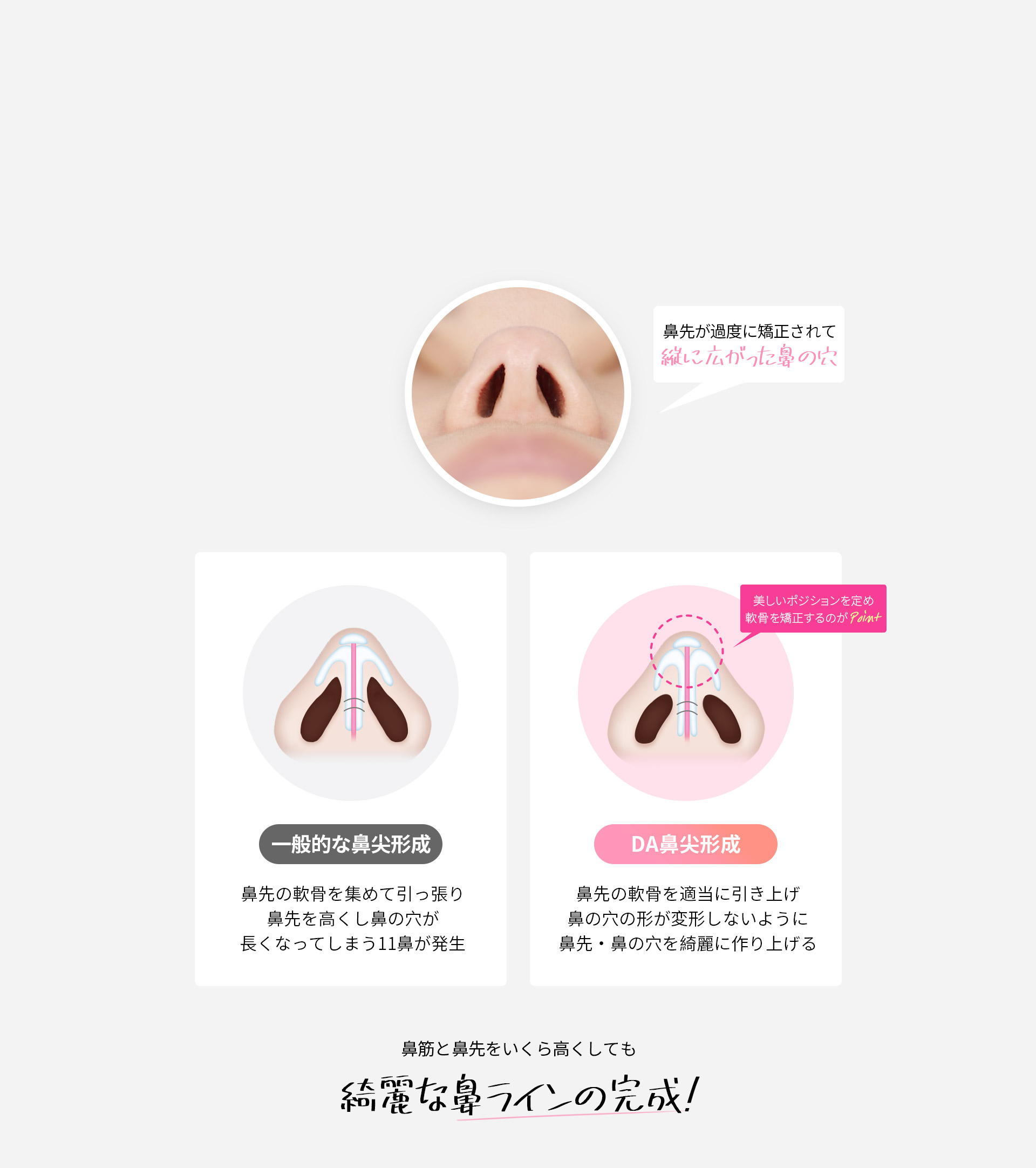 DA2度目の鼻整形