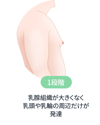 DA 女性化乳房