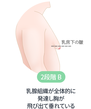 DA 女性化乳房