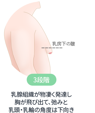 DA 女性化乳房