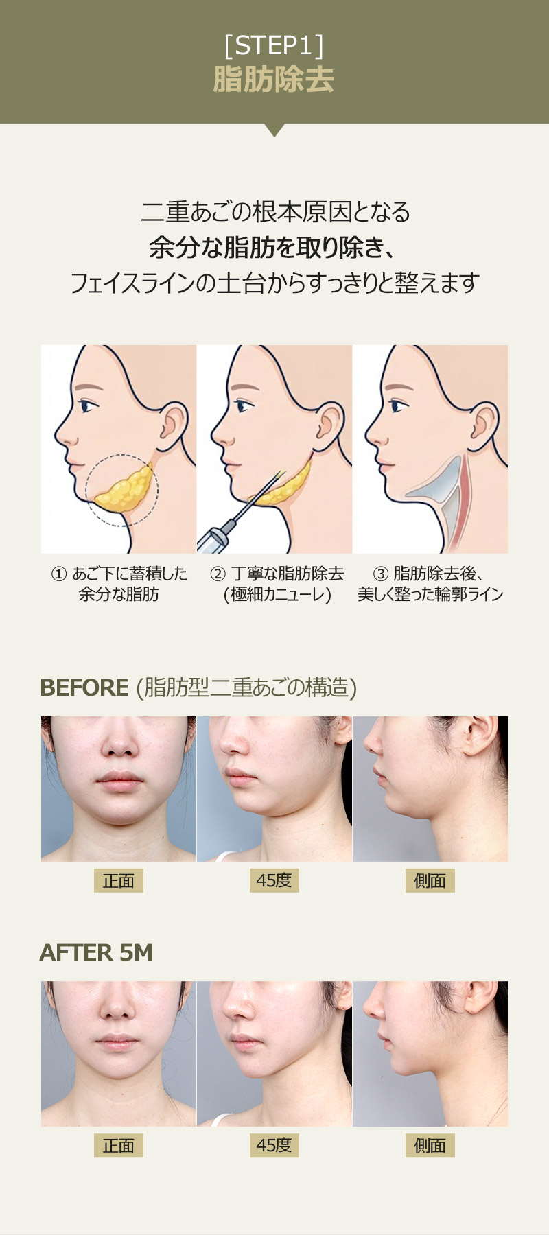 二重あごの根本原因となる余分な脂肪を取り除き、フェイスラインの土台からすっきりと整えます