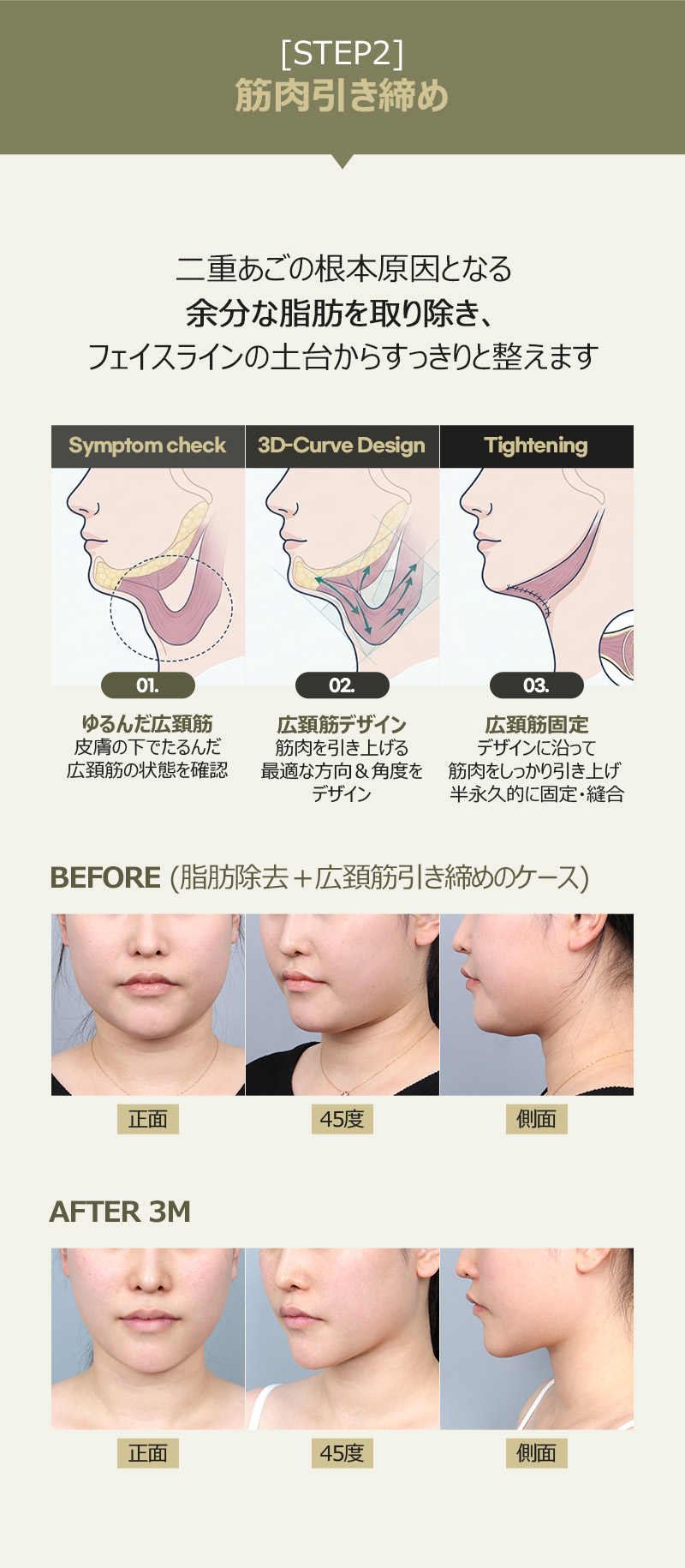 二重あごの根本原因となる余分な脂肪を取り除き、フェイスラインの土台からすっきりと整えます