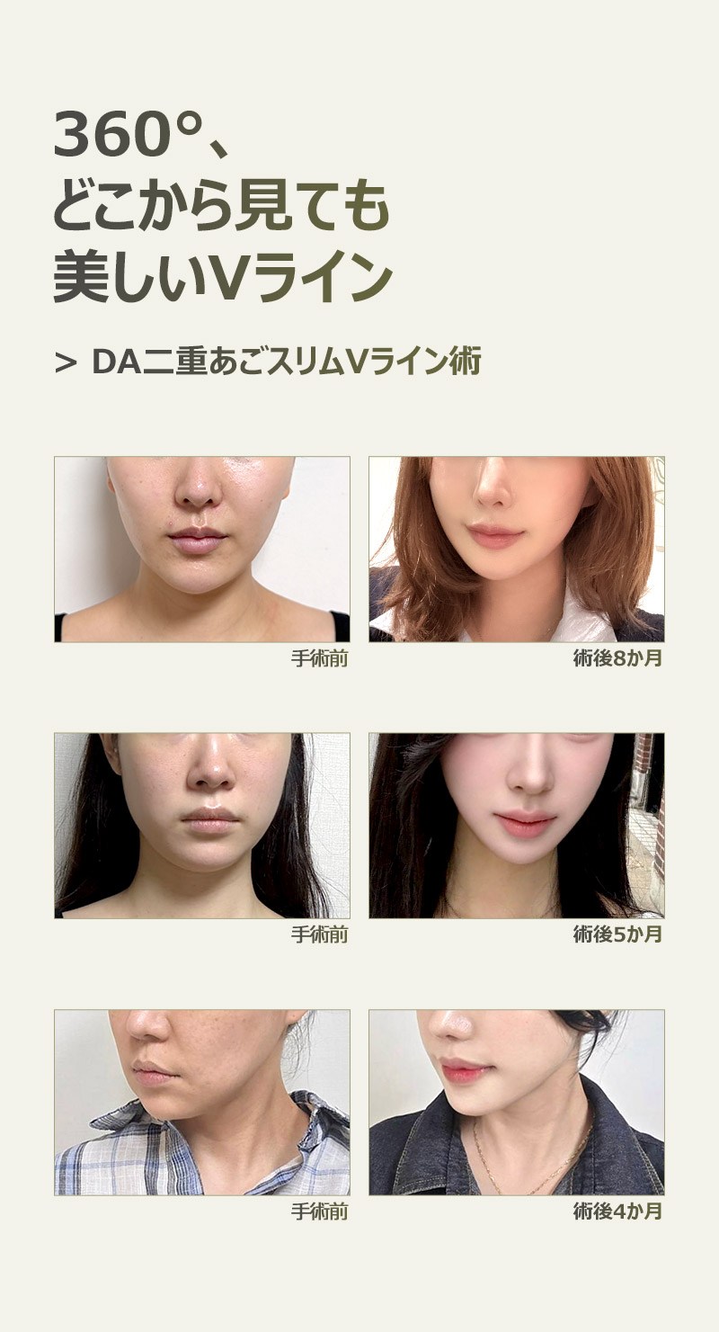 DA二重あごスリムVライン術