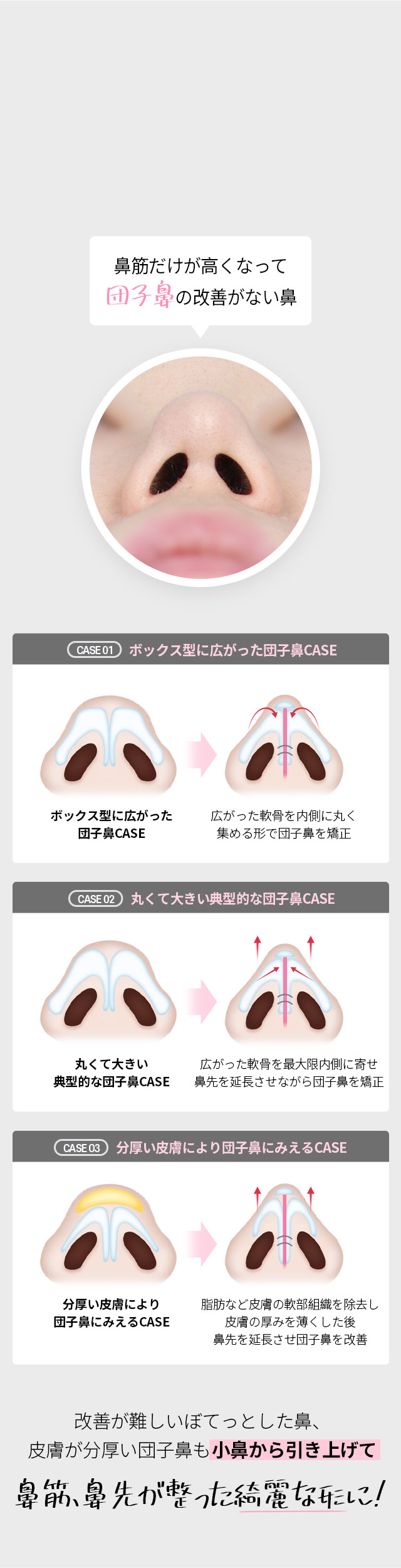 DA2度目の鼻整形