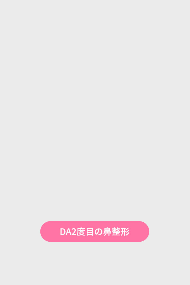 DA2度目の鼻整形