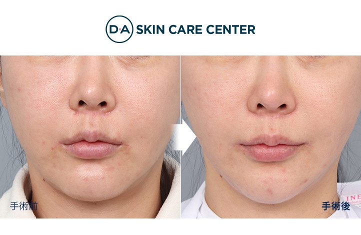 ウルセラ前後写真