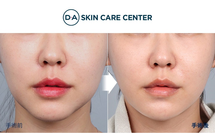 ウルセラ前後写真