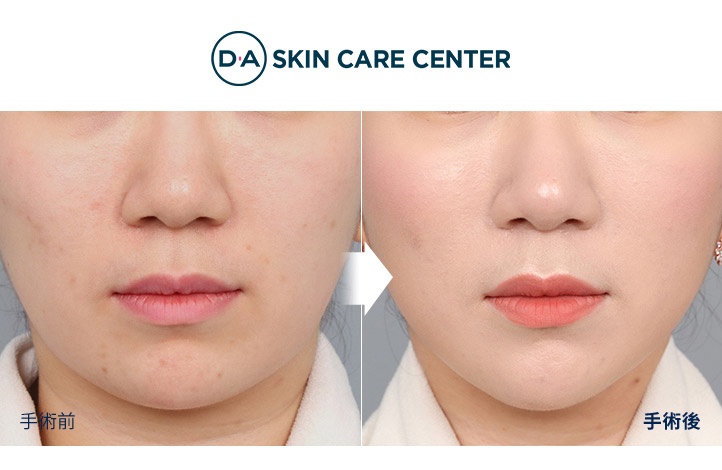 ウルセラ前後写真