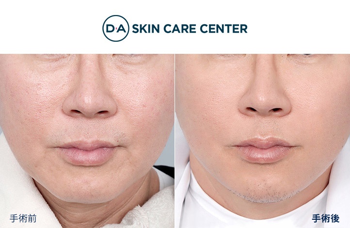 ウルセラ前後写真