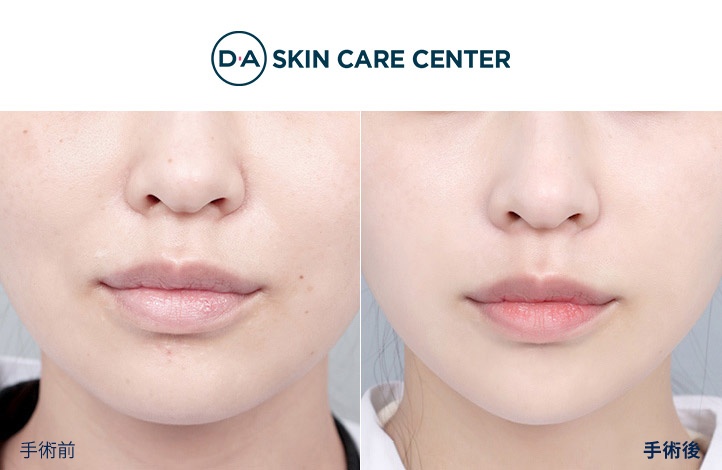 ウルセラ前後写真