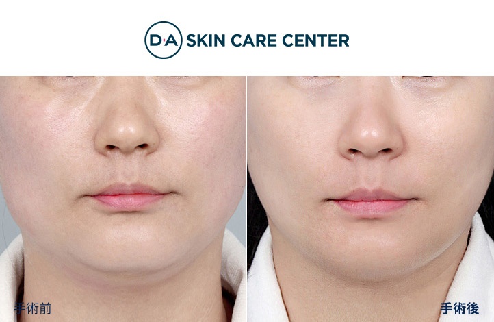 ウルセラ前後写真