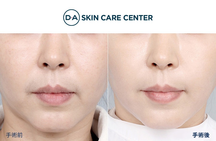 ウルセラ前後写真