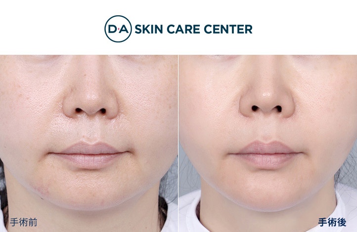 ウルセラ+インモードリフティング+うるつやスキンボトックス前後写真