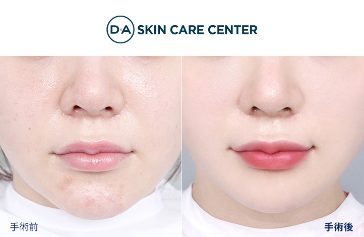 ウルセラ前後写真