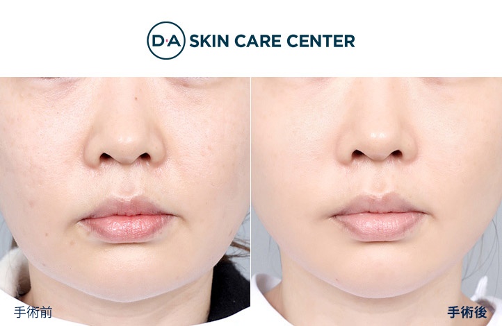 ウルセラ前後写真