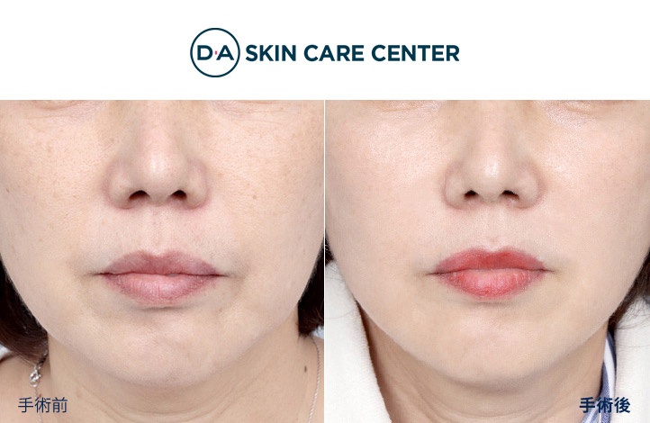 ウルセラ前後写真