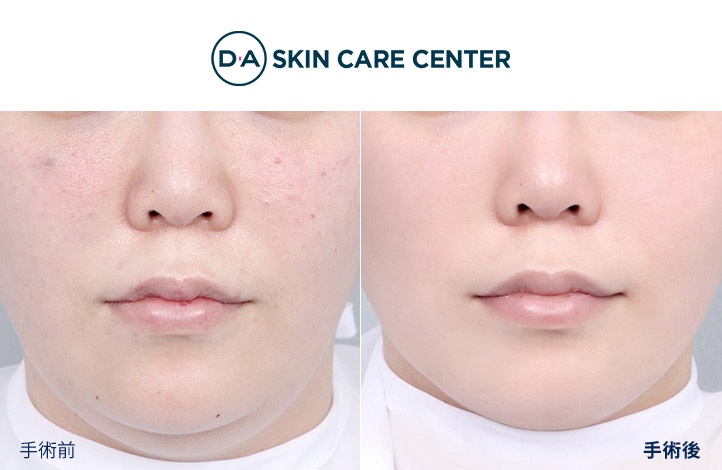 ウルセラ前後写真