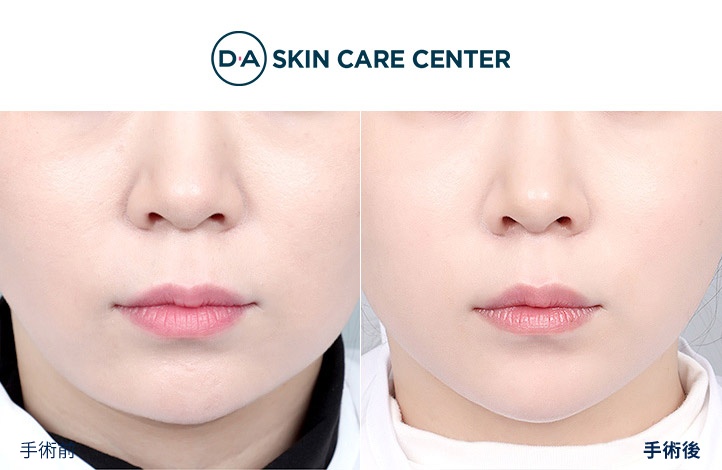 ウルセラ前後写真