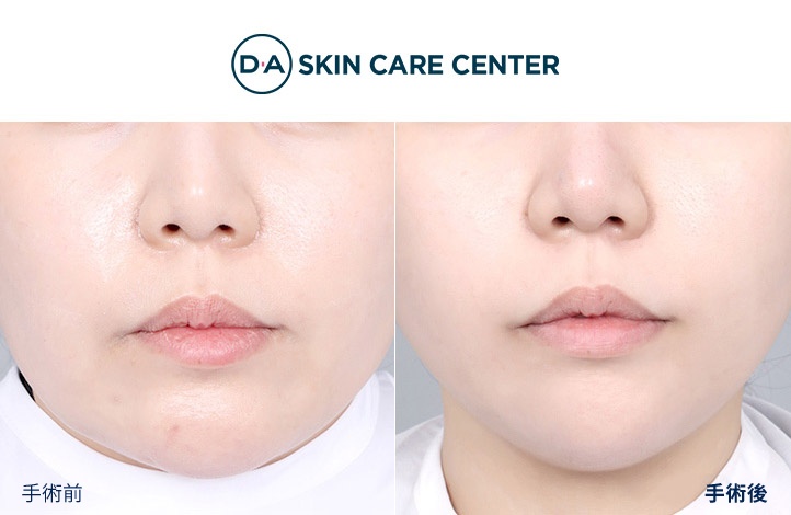 ウルセラ前後写真