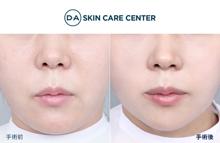 ウルセラ前後写真