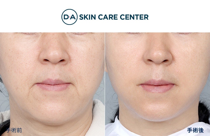 ウルセラ前後写真