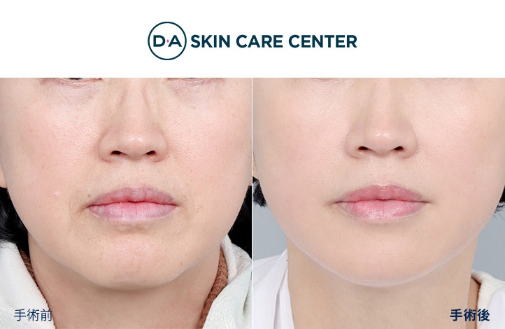 ウルセラ前後写真