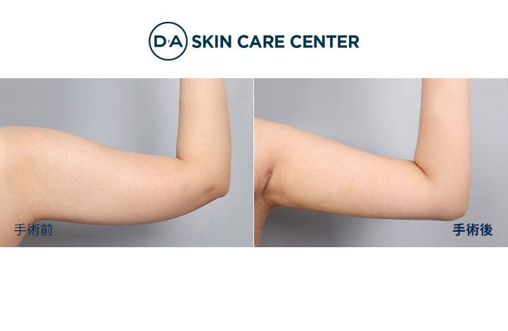 二の腕の脂肪吸引前後写真