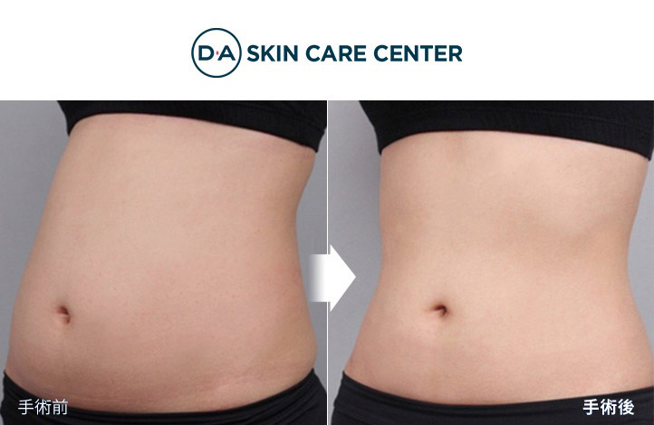 リポソニック脂肪吸引前後写真