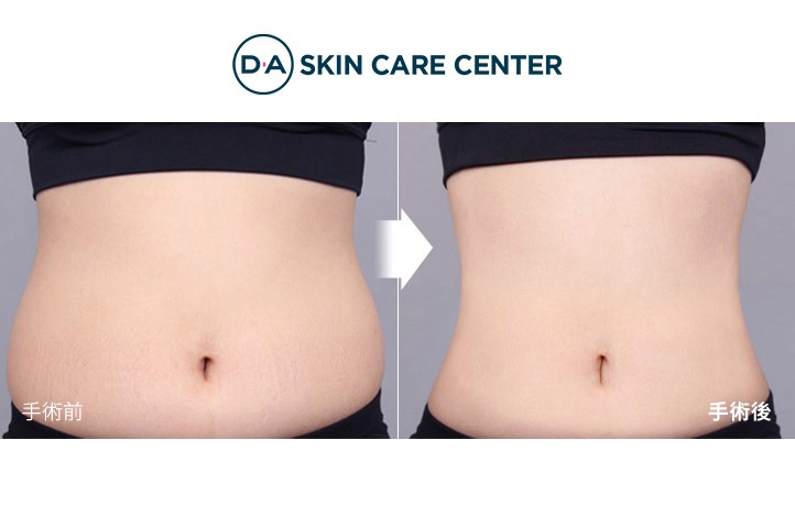 腹部脂肪吸引前後写真
