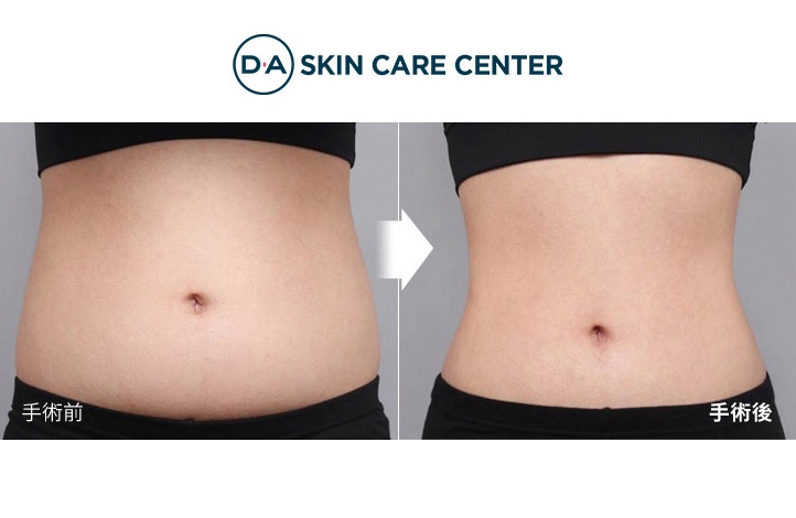 腹部脂肪吸引前後写真