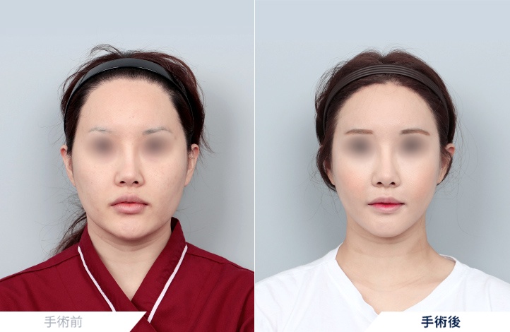 シェイピング顔面輪郭[輪郭3点]+アキュスカルプ+フルフェイス脂肪移植前後写真