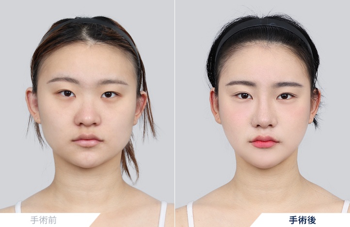 輪郭3点+ミニリフト+ミント糸リフト前後写真