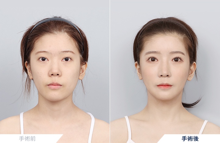 輪郭3点 + 目整形 + 鼻整形 + 脂肪移植前後写真