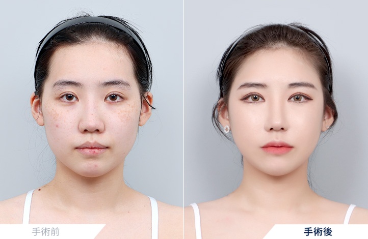 頬骨縮小+エラ削り+オトガイ形成+脂肪移植前後写真