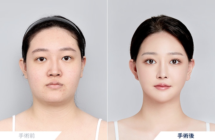 両顎手術+輪郭3点+非切開目つき矯正+鼻整形+ミニリフト前後写真