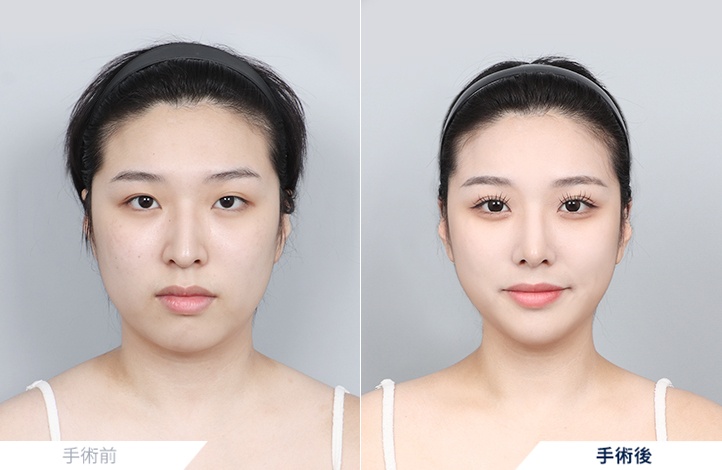 オトガイ形成+目整形+鼻整形+脂肪移植(額)前後写真