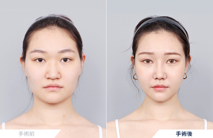 頬骨縮小+鼻整形+アキュスカルプ前後写真
