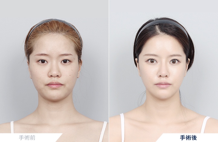 輪郭3点+目整形+鼻整形+脂肪移植前後写真