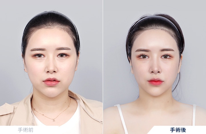 頬骨縮小+エラ削り+オトガイ形成+アキュスカルプ+鼻再手術前後写真